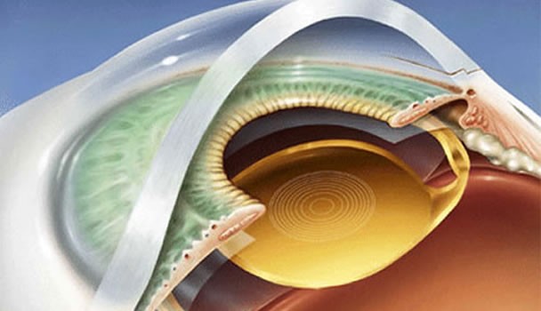 Lentes Intraoculares Premium: A Revolução na Cirurgia de Catarata