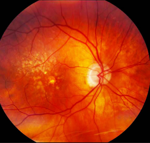 Degeneração Macular Relacionada à Idade (DMRI): Como Prevenir e Tratar?